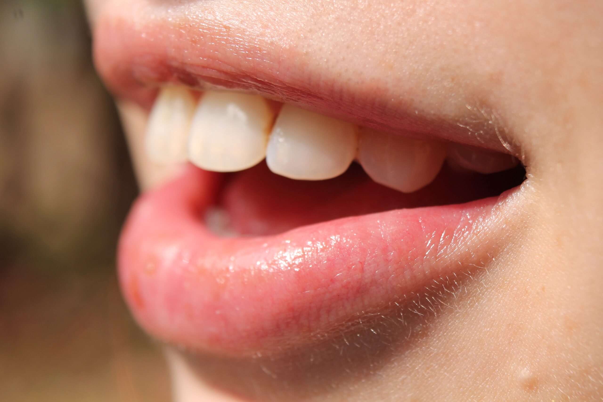 Dental Sealants